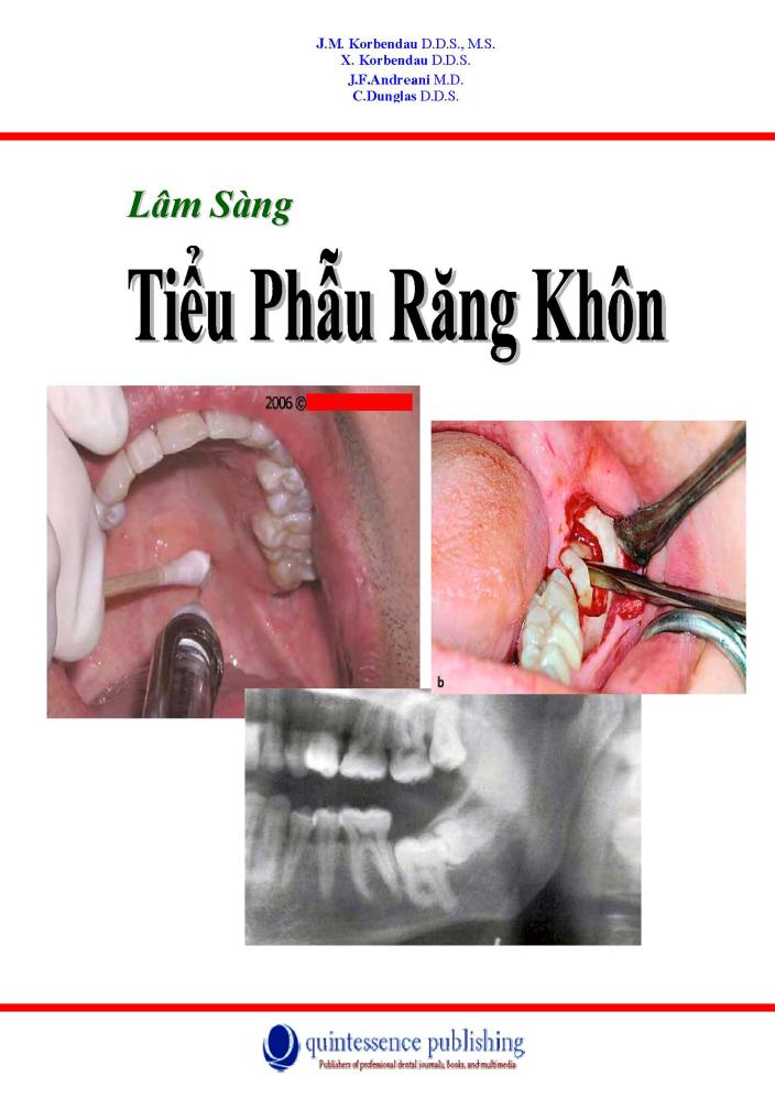 Tiểu phẫu răng khôn: Quy trình, lưu ý và chi phí